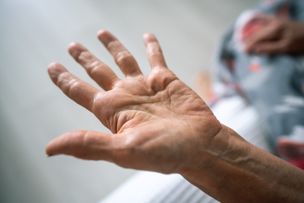 Dupuytren te zien in de handpalm van een oudere man